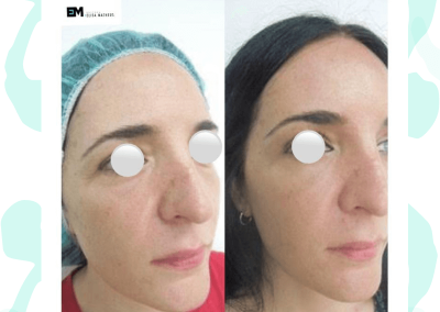 Resultados de tratamientos de ojeras. Caso 1