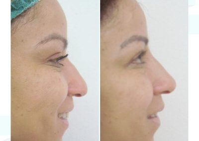 Dra Elisa Matheus Rinomodelacion (1)