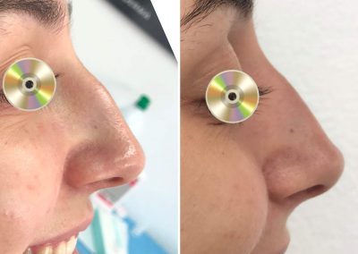 Dra Elisa Matheus Rinomodelacion (10)