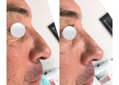 Dra Elisa Matheus Rinomodelacion (11)