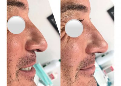 Dra Elisa Matheus Rinomodelacion (12)