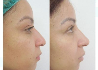 Dra Elisa Matheus Rinomodelacion (3)