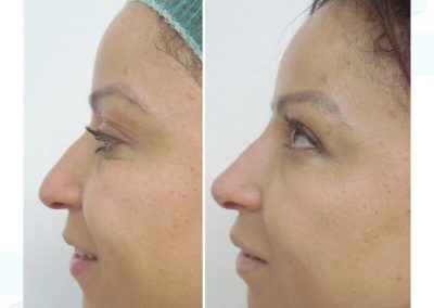 Dra Elisa Matheus Rinomodelacion (4)