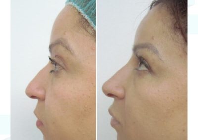 Dra Elisa Matheus Rinomodelacion (5)