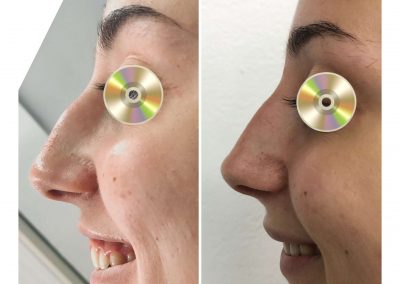 Dra Elisa Matheus Rinomodelacion (8)