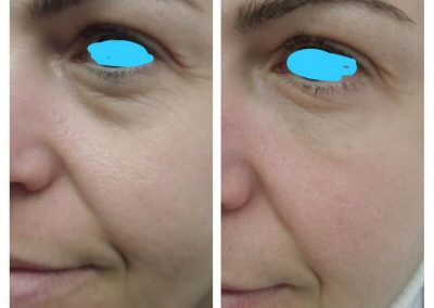 Resultados de tratamientos de ojeras. Caso 2