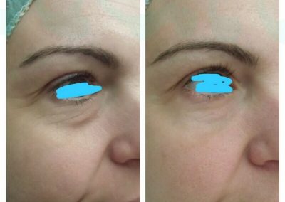 Resultados de tratamientos de ojeras. Caso 3