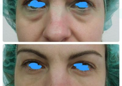 Resultados de tratamientos de ojeras. Caso 4