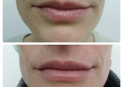 Resultados de rellenos de labios Dra Elisa Matehus (7)